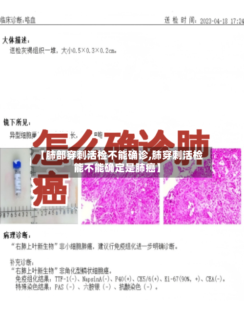 【肺部穿刺活检不能确诊,肺穿刺活检能不能确定是肺癌】