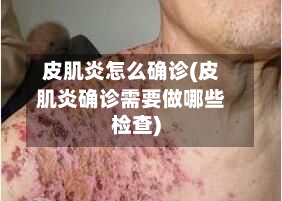 皮肌炎怎么确诊(皮肌炎确诊需要做哪些检查)