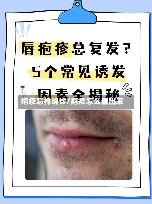 疱疹怎样确诊/疱疹怎么看出来