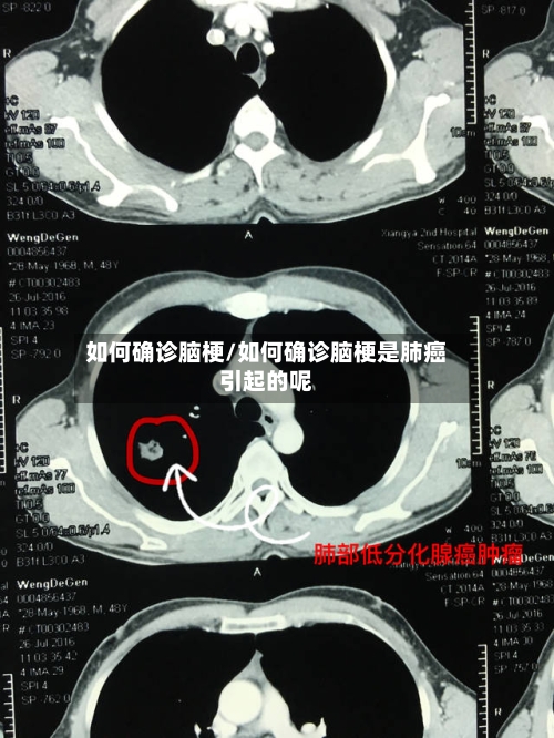 如何确诊脑梗/如何确诊脑梗是肺癌引起的呢