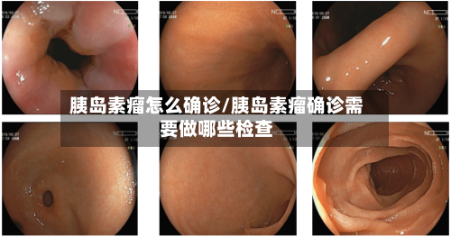 胰岛素瘤怎么确诊/胰岛素瘤确诊需要做哪些检查