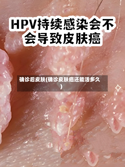 确诊后皮肤(确诊皮肤癌还能活多久)