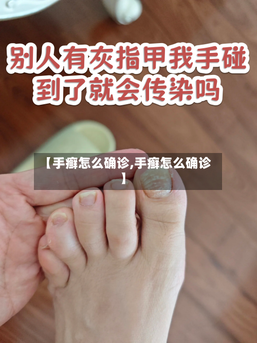 【手癣怎么确诊,手癣怎么确诊】