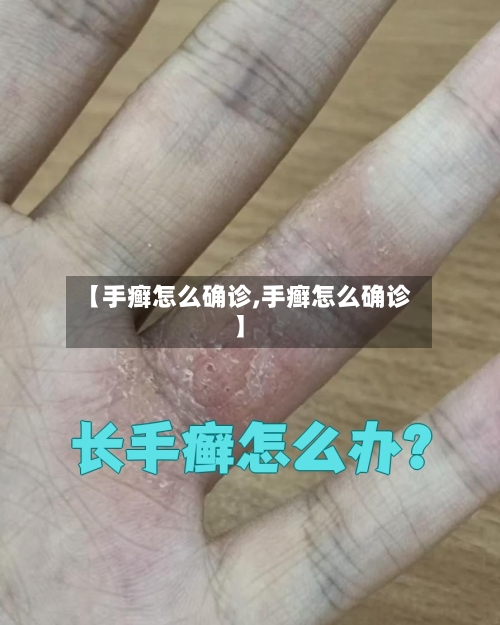 【手癣怎么确诊,手癣怎么确诊】