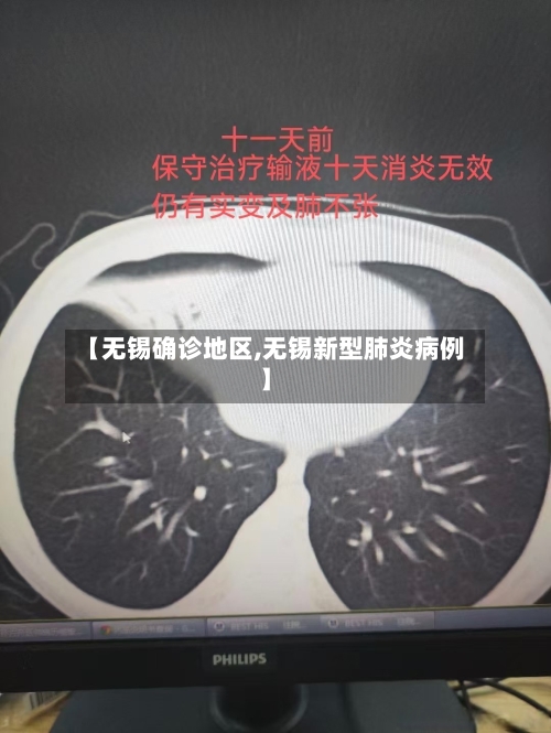 【无锡确诊地区,无锡新型肺炎病例】