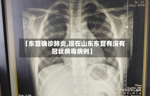 【东营确诊肺炎,现在山东东营有没有冠状病毒病例】